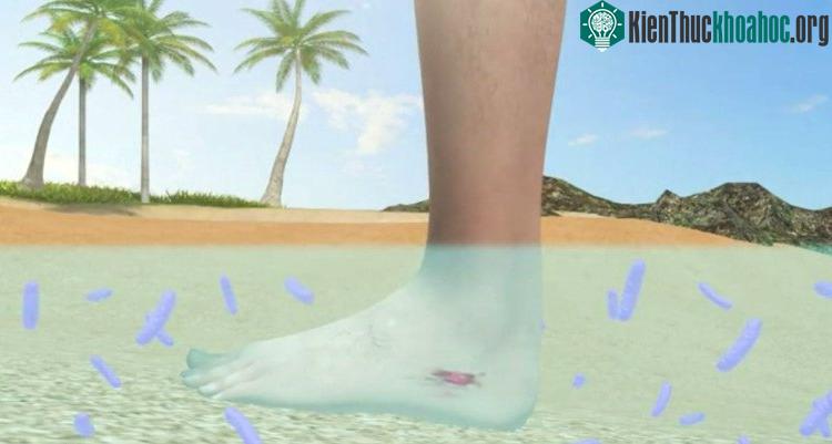 Vi khuẩn ăn thịt người có thể lọt vào cơ thể thông qua vết thương hở dưới nước.