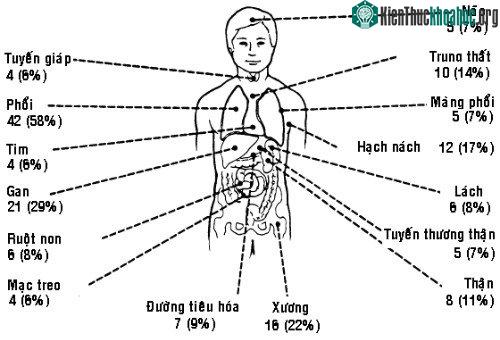 Các vị trí có thể di căn.