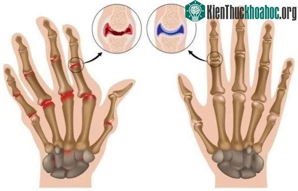 Một bàn tay phải bị viêm khớp​.