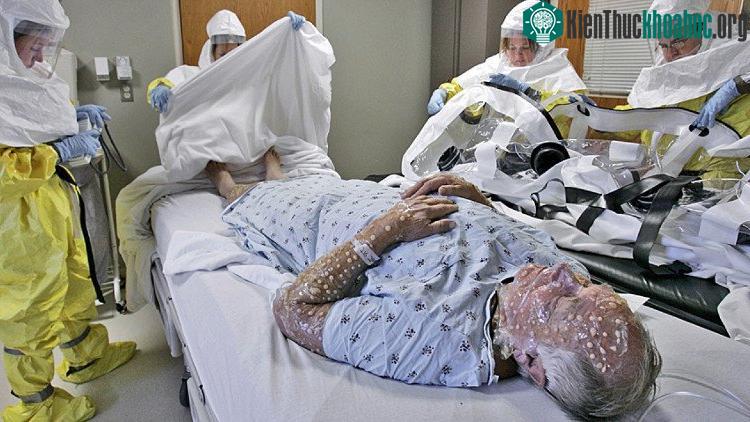 Nhà khoa học Canada tổng hợp thành công virus đậu mùa, nguy cơ đại dịch bệnh chết người quay trở lại.