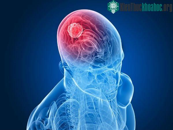 Triệu chứng của ung thư não phụ thưộc chủ yếu vào kích thước và vị trí của khối u trong não.