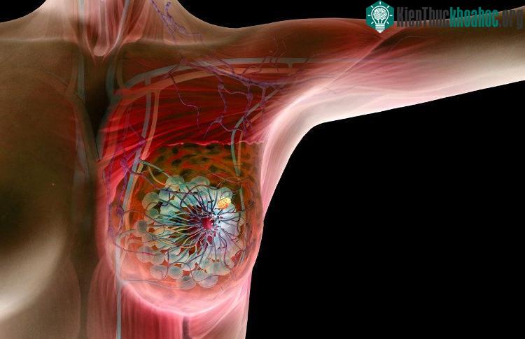 Nhỏ lông nách và dùng chất khử mùi cùng lúc sẽ làm gia tăng nguy cơ mắc ung thư vú gấp đôi.