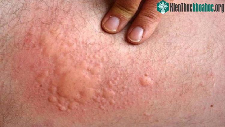 Cơ thể sẽ phản ứng để đào thải khi phát hiện "vật lạ" trong máu.