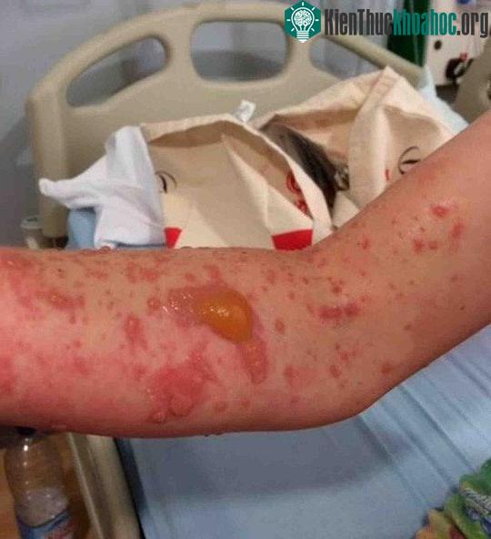 Vết thương gây ra bởi ngò tây khổng lồ.
