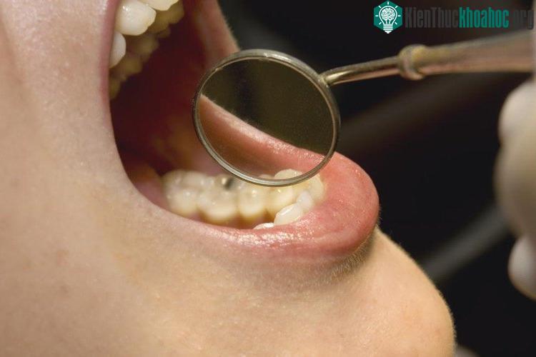 Người mắc bệnh nướu răng có nguy cơ ung thư khi về già. (Ảnh: UPI).