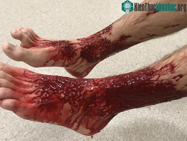 Sam được đưa vào bệnh viện cấp cứu với 2 chân đầy máu.