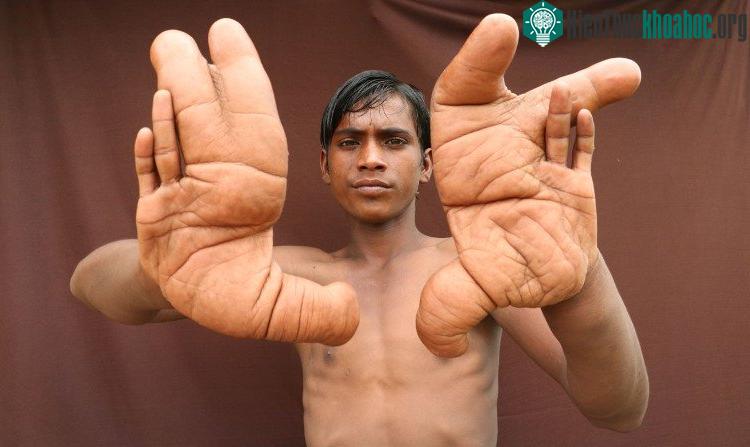 Bàn tay khổng lồ của Tarik. (Ảnh: Barcroft).