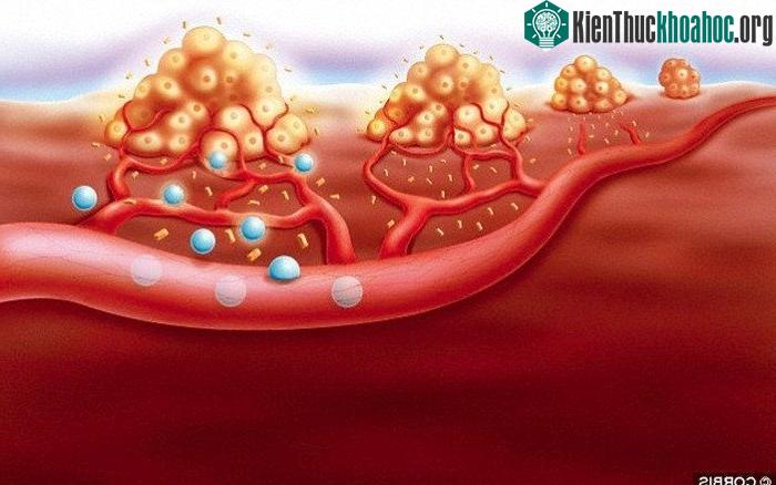 20-HETE hỗ trợ quá trình hình thành mạch máu nuôi sống tế bào ung thư.