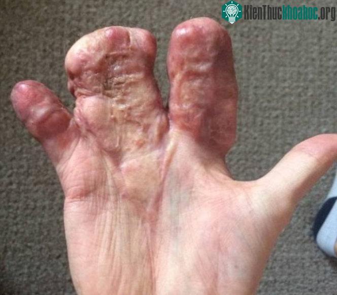 Hiện tại anh mới trải qua thêm 2 cuộc phẫu thuật để tách khối ngón tay làm 3.