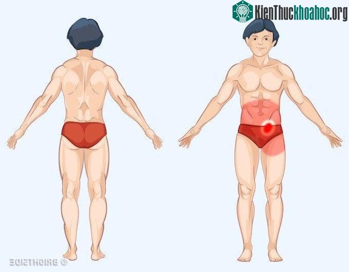 Ruột thừa nằm ở bụng dưới bên phải nhưng cơn đau do bộ phận này gây ra có thể ảnh hưởng đến toàn bộ vùng dạ dày