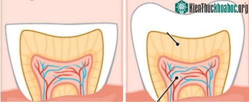 Răng khỏe mạnh và răng mòn do nghiến răng.