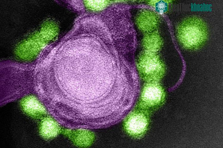 Tế bào ung thư não glioblastoma. (Ảnh: Sherbrooke connectivity imaging lab/ Science photo library).
