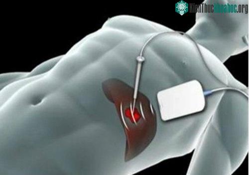 Kỹ thuật điều trị u gan bằng vi sóng. (Ảnh: asiancancer).