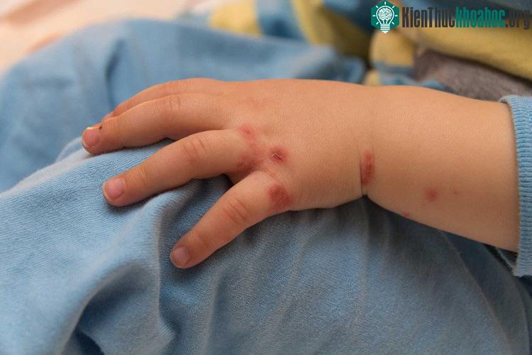 Biểu hiện bệnh tay chân miệng là bóng nước có kích thước 2-10mm, trẻ có thể sốt nhẹ, quấy do đau miệng, bỏ ăn….