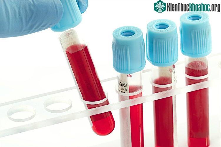 Xét nghiệm máu tổng quát khá đơn giản.