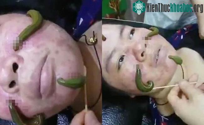 Con đỉa vừa hút máu độc ở ổ mụn, vừa tiết ra dịch giúp các mô tế bào nhanh lành.