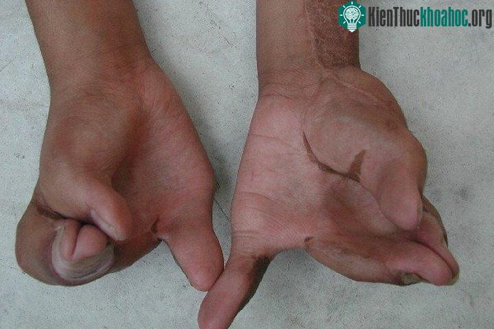 Các ngón tay bị dính vào nhau và co quắp.