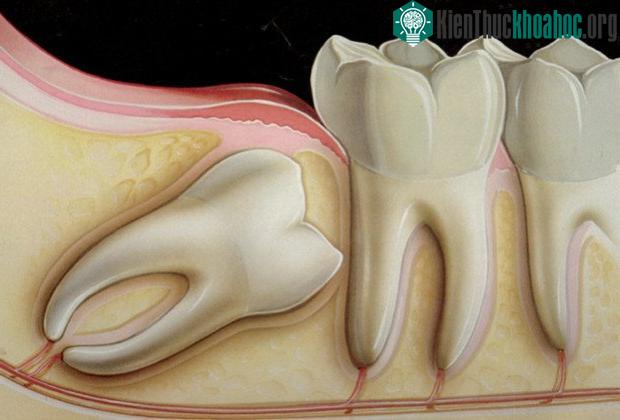 Nguyên nhân gây ra sự khác biệt này chính là loại gene PAX9 (paired box gene 9).