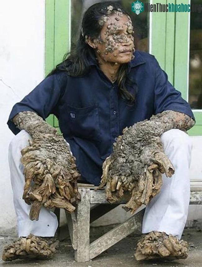 Bệnh người cây