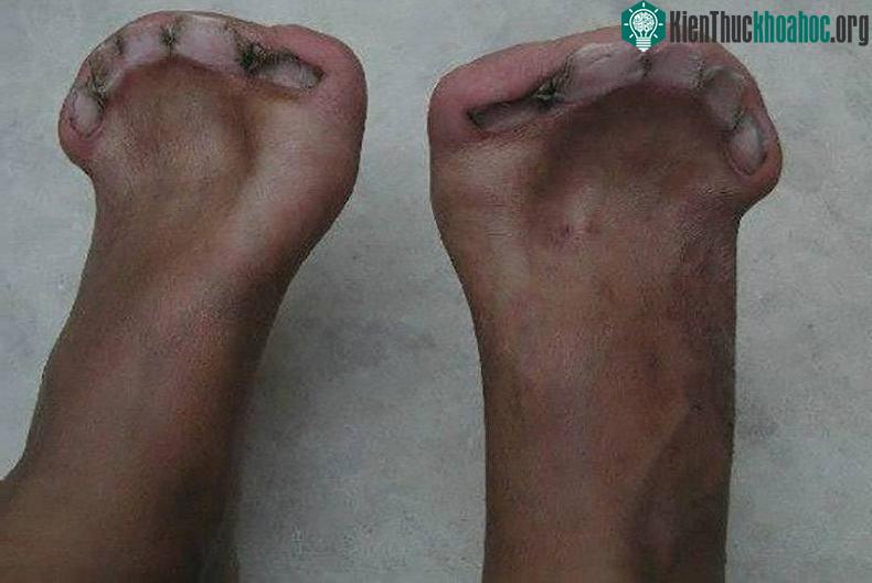 Bàn chân dị dạng với 5 móng chân nhưng hoàn toàn không có ngón.