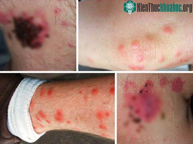 Những cú cắn của rệp giường sẽ khiến nạn nhân ngứa ngáy, khó chịu.