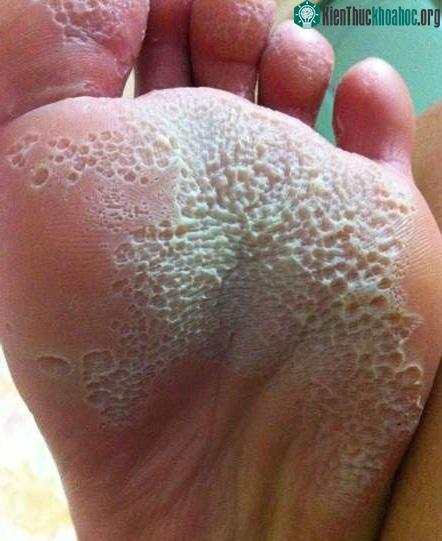 Bệnh Tungiasis