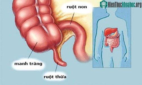 Vị trí của ruột thừa trong cơ thể. (Ảnh: WebMD).