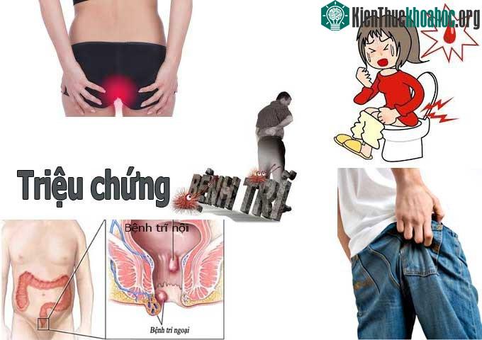 Người bệnh khi mắc bệnh trĩ lúc đầu chảy máu ít.