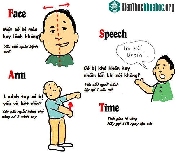 4 dấu hiệu phát hiện người bị đột quỵ.