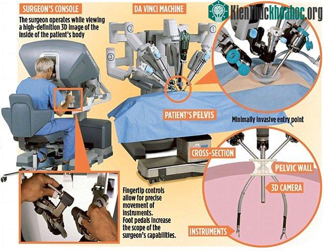 Hình ảnh mô phỏng ca phẫu thuật phối hợp giữa con người và "siêu robot" Da Vinci - (ảnh: DAILY MAIL).