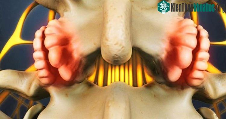 Ảnh mô phỏng gai cột sống. (Ảnh: Maple Healthcare).