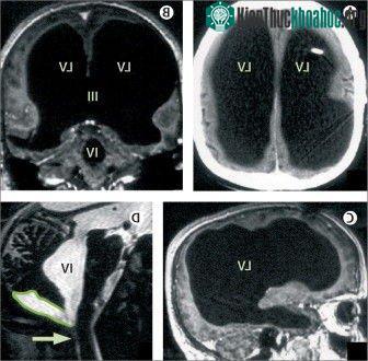 Lớp dịch đã "nuốt" hết não của ông, chỉ để lại phần vỏ não chứa các neuron thần kinh.