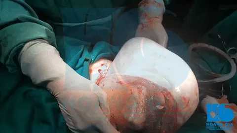 Trẻ sinh ra trong bọc điều.