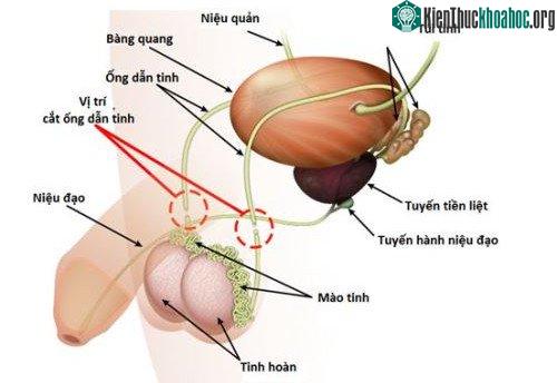 Vị trí cắt ống dẫn tinh.