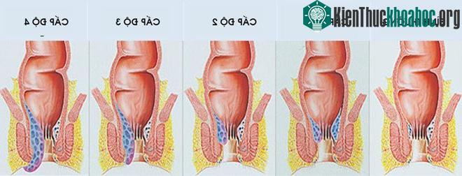 Các cấp độ của trĩ.