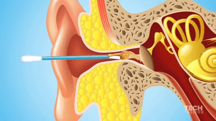 Đối với những người cơ chế tự lành sạch bị lỗi, bạn có thể sử dụng bông ngoáy tai, nhưng ít thôi.