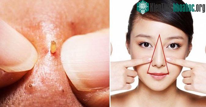 Nếu muốn nặn mụn, hãy đảm bảo sát trùng tay và dụng cụ thật sạch sẽ.