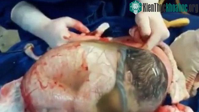 Một trường hợp em bé sinh ra trong bọc ối từng gây bão cư dân mạng.