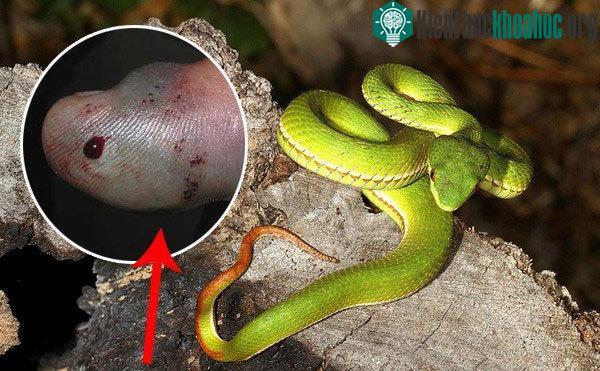 Ngón tay của nạn nhân sưng phồng lên vì rắn lục đuôi đỏ cắn.