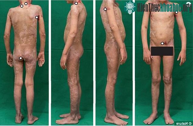 Sau một thời gian ghép da, da cậu bé đã bắt đầu được tái tạo - (ảnh: NATURE).