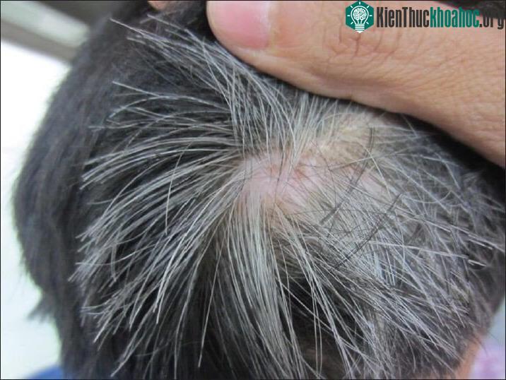 Tóc bạc là sản phẩm của bộ gene, phụ thuộc nhiều vào melanin trong cơ thể.
