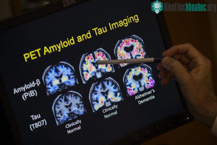 Theo nghiên cứu mới đây, có thể có cách "trị" bệnh Alzheimer mà không cần đến thuốc - (Ảnh: AP).