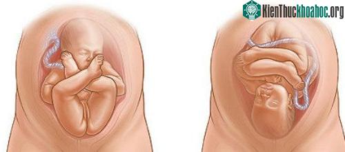 Thai nhi bình thường và thai ngôi mông (bên phải). (Ảnh: uofmhealth).