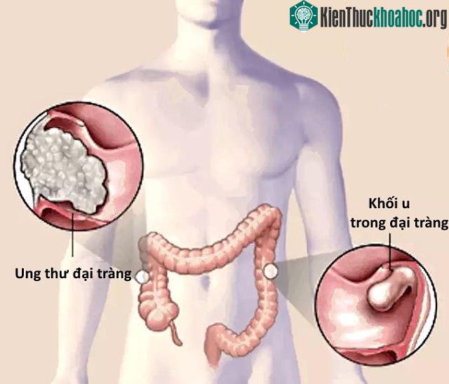Tốt nhất nên nội soi đại tràng định kỳ hàng năm từ khi còn là thanh niên. (Ảnh: News).