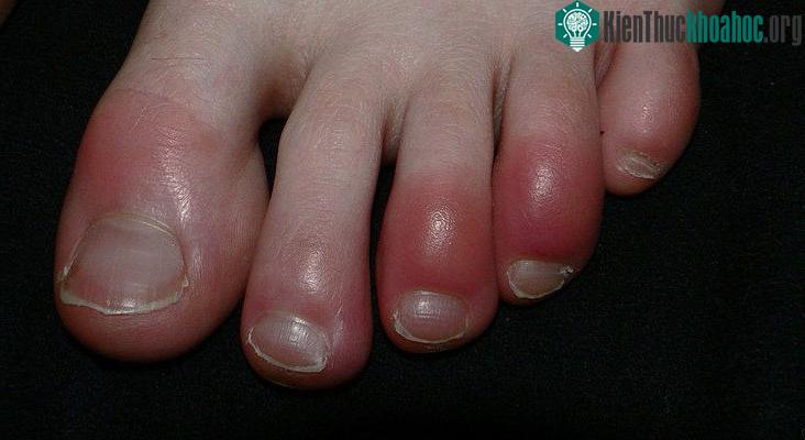 Cước chân vào mùa lạnh.