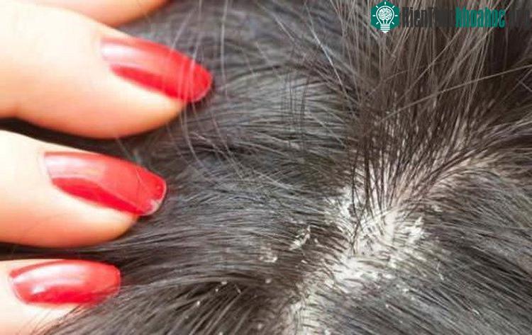 Nhiều người cho rằng chính da đầu bị khô đã sinh ra các vảy trắng li ti.