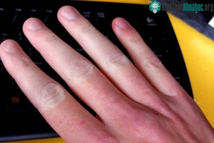Raynaud có thể khiến bạn đau đớn, cảm giác tê bì, kim châm đầu ngón tay, chân.