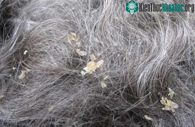 Mỗi tuần nên gội đầu khoảng 2 - 3 lần, tình trạng gàu sẽ giảm.