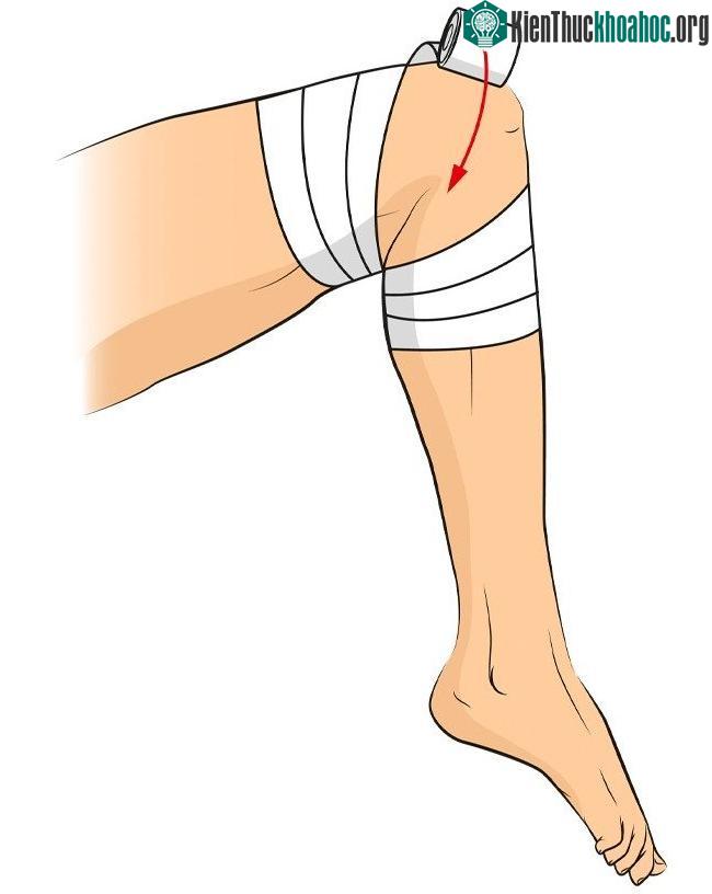 Trong trường hợp đầu gối bị thương, cách băng bó trên sẽ rất hữu ích, giúp cố định phần khớp.