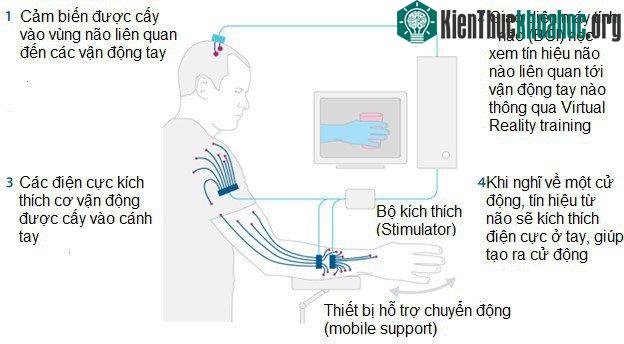 BCI hỗ trợ Kochevar cử động cánh tay. (Nguồn ảnh: The Guardian).
